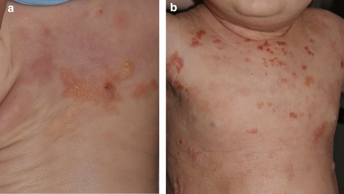 Pediatric Mastocytosis: Recognition and Management | SpringerLink