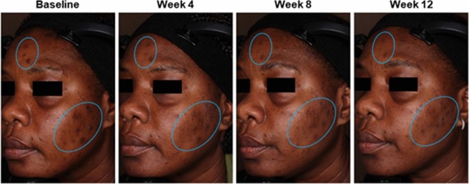 Effects of Topical Retinoids on Acne and Post-inflammatory  Hyperpigmentation in Patients with Skin of Color: A Clinical Review and  Implications for Practice | American Journal of Clinical Dermatology