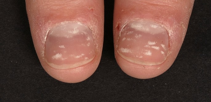 Leukonychia: What Can White Nails Tell Us? | SpringerLink Leukonychia: What Can White Nails Tell Us? | SpringerLink
