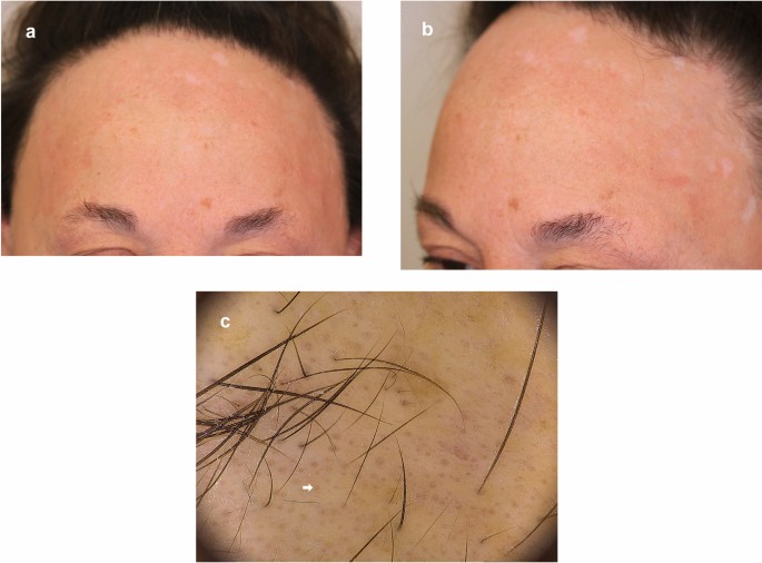 Eyebrow and Eyelash Alopecia: A Clinical Review | SpringerLink