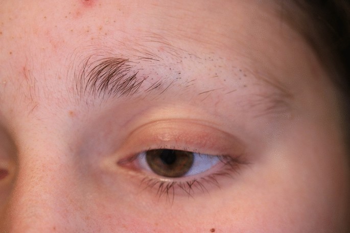 Eyelash  eyebrow loss and your thyroid  Lisa CostaBir