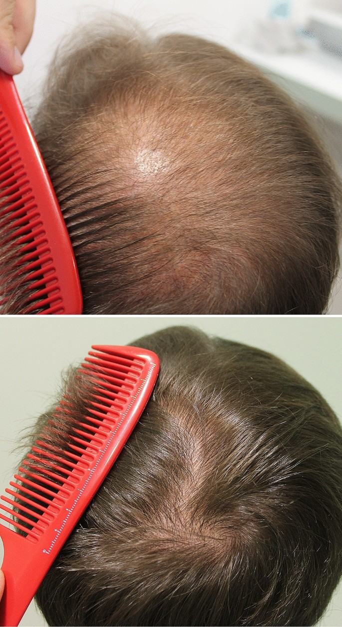 Comparison of oral minoxidil finasteride and dutasteride for treating  androgenetic alopecia