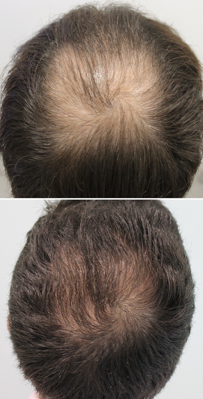 Whats New in Therapy for Male Androgenetic Alopecia  SpringerLink