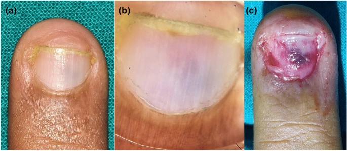Blue Nail Discoloration: Literature Review and Diagnostic Algorithms |  American Journal of Clinical Dermatology | Springer Nature Link