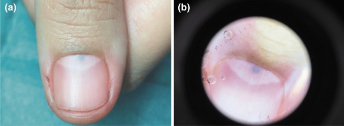 Blue Nail Discoloration: Literature Review and Diagnostic Algorithms | American Journal of Clinical Dermatology