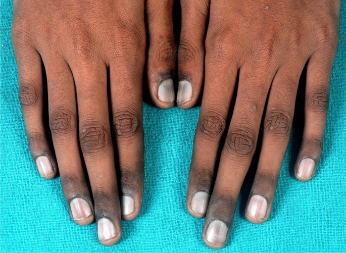 Blue nails: window to micronutrient deficiency | BMJ Case Reports