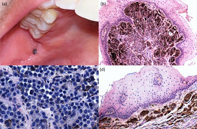 Pigmented Lesions of the Oral Mucosa: Clinical Presentation, Histology, and  Recommendations for Management | American Journal of Clinical Dermatology |  Springer Nature Link