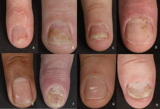 onycholysis psoriasis