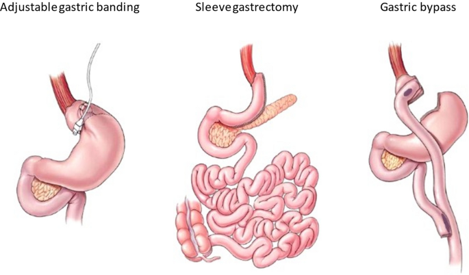 tirzepatide and gastric bypass Pharmacotherapy as an Augmentation to Bariatric Surgery for Obesity | Drugs
