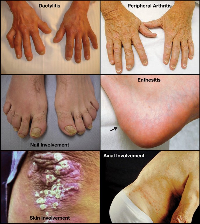 psoriasis arthritis)