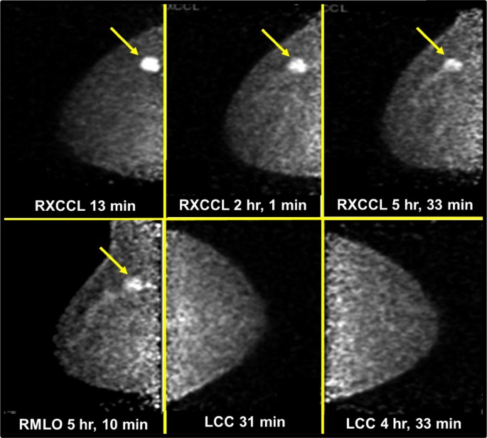 Advanced Approaches To Imaging Primary Breast Cancer An Update Springerlink