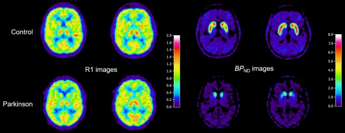 Tien badminton Salie Dopamine transporter imaging in neurodegenerative movement disorders: PET  vs. SPECT | SpringerLink
