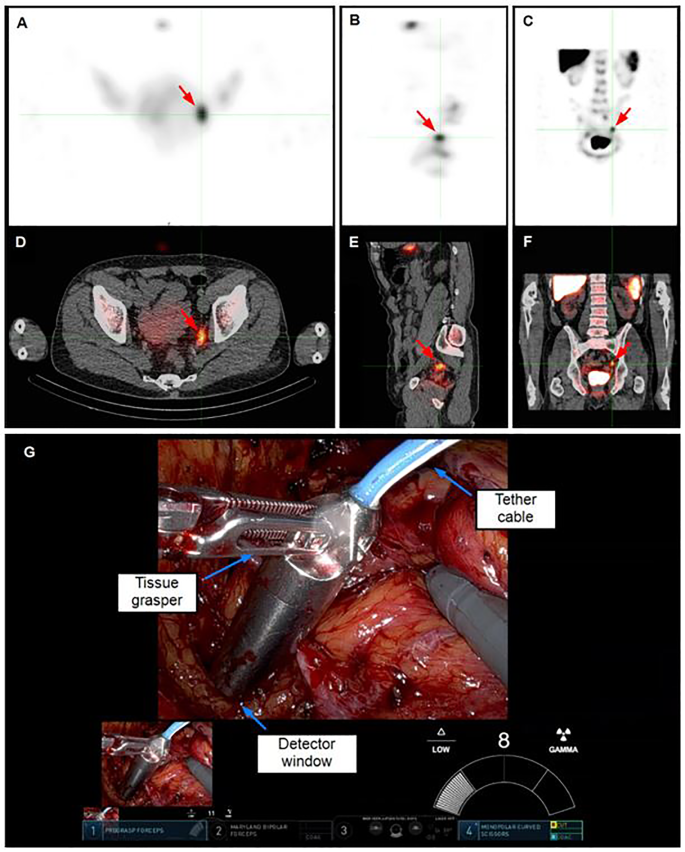 Sentinel Line Tracing Correlation of tracer uptake in sentinel lymph nodes as measured on ...