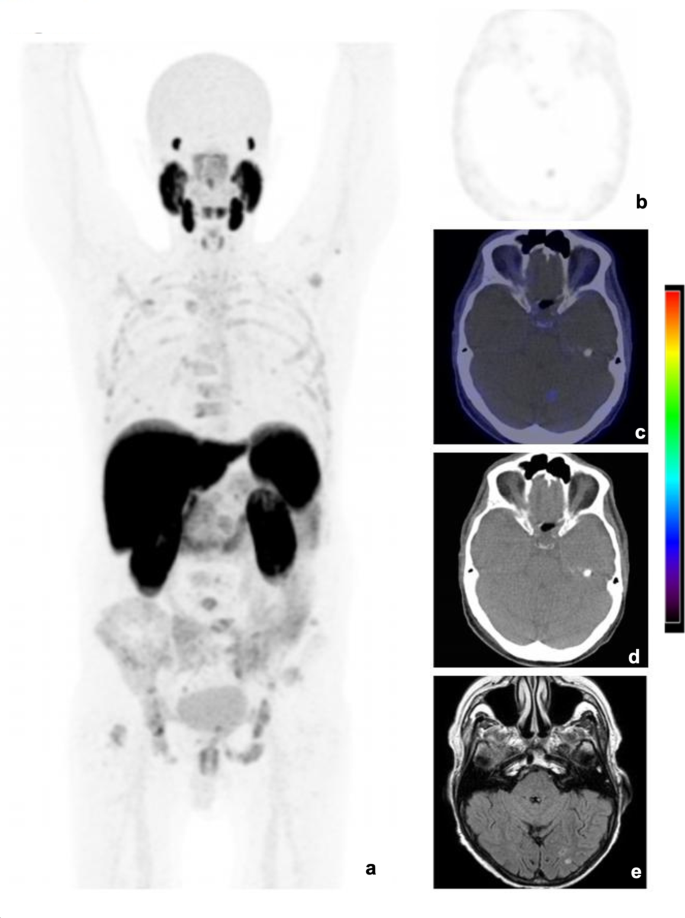 PSMA PET in brain metastases: navigating diagnostic challenges– a ...