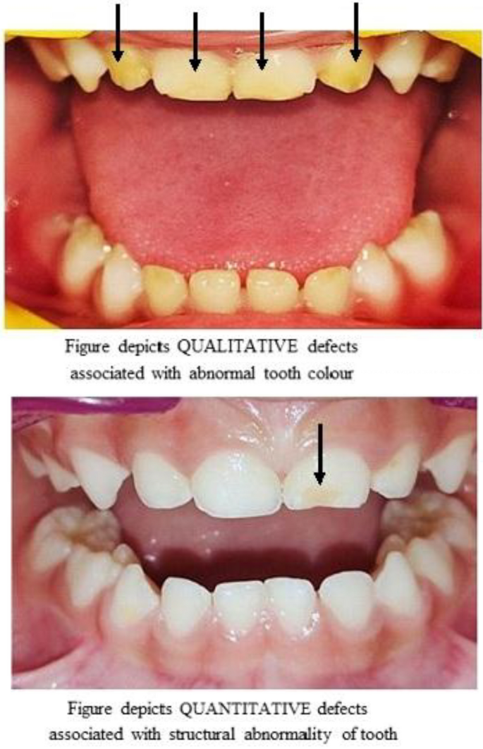 Impact of perinatal risk factors on developmental defect of enamel and ...