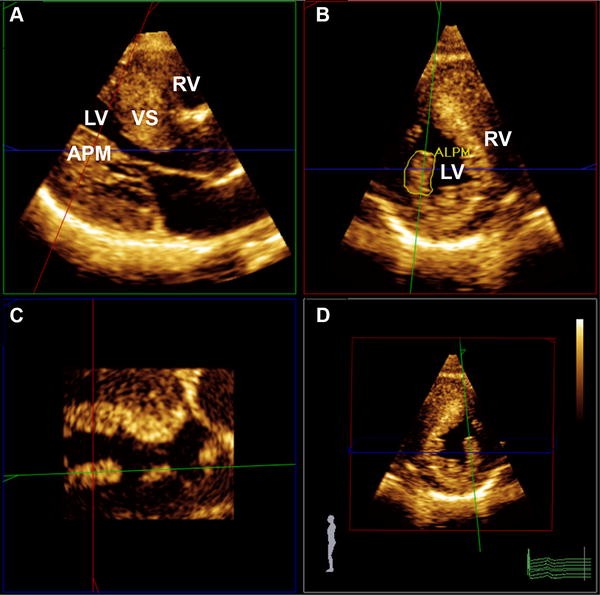 Three Dimensional Echocardiography For The Assessment Of Left Ventricular Geometry And Papillary Muscle Morphology In Hypertrophic Cardiomyopathy Springerlink