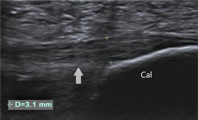 plantar fasciitis ultrasound