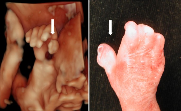 Rubinstein- Taybi Syndrome Congenital Hand and Arm Differences