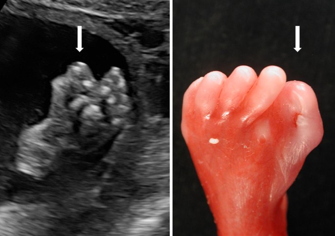 Rubenstein-Taybi Syndrome  April is diagnosed with Rubinstein