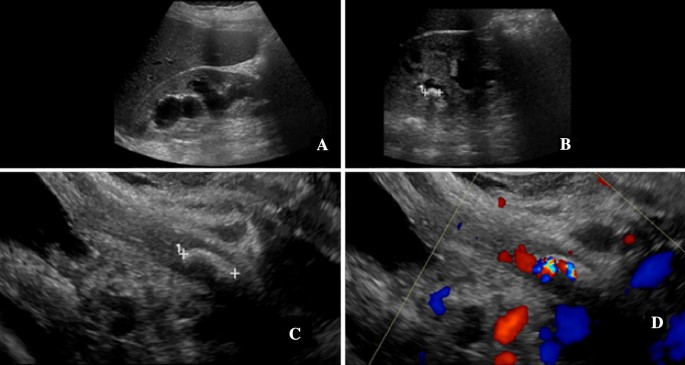 Detection Of Distal Ureteral Stones In Pregnancy Using Transvaginal Ultrasound Springerlink