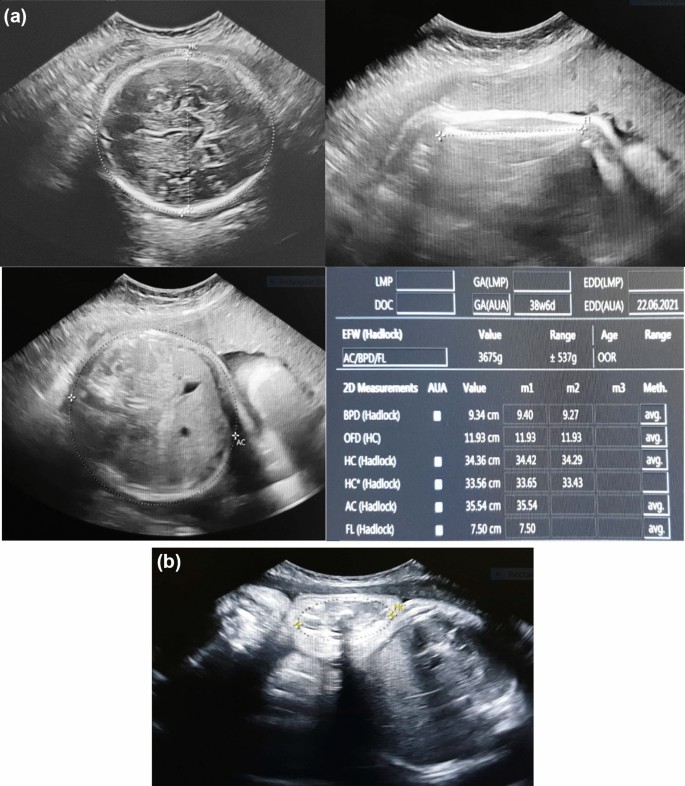 Ultrasonographic fetal thigh measurement the estimation of fetal weight based on formula in women with an engaged fetal head in the pelvis: a study | SpringerLink