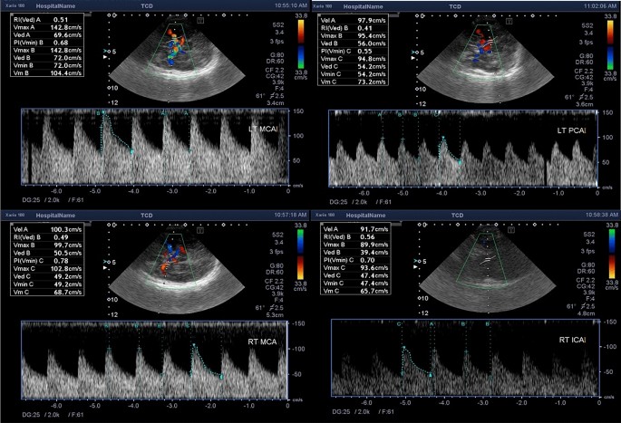 Role of transcranial Doppler in assessment of cerebral blood flow 