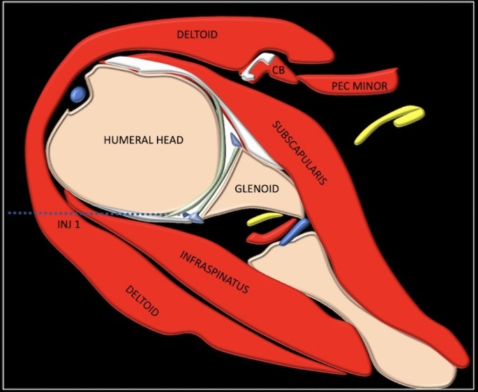 GIBPS technique—a novel sequential technique of performing shoulder ...