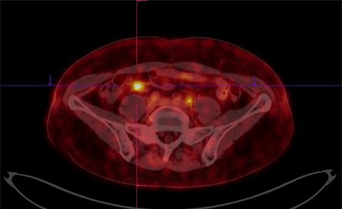 64 Cu Dotatoc Pet Ct In Patients With Neuroendocrine Tumors Springerlink