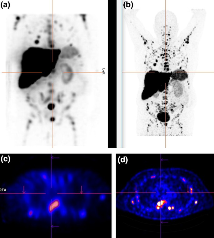 64 Cu Dotatoc Pet Ct In Patients With Neuroendocrine Tumors Springerlink