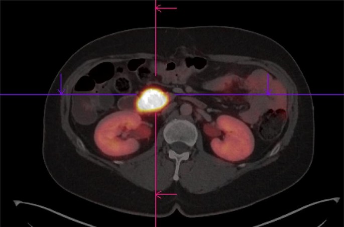 64 Cu Dotatoc Pet Ct In Patients With Neuroendocrine Tumors Springerlink