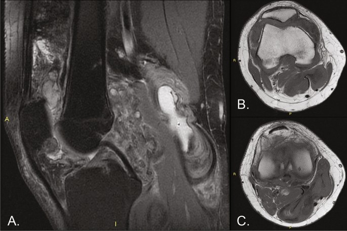 Pexidartinib Upfront in a Case of Tenosynovial Giant Cell Tumor: Proof ...