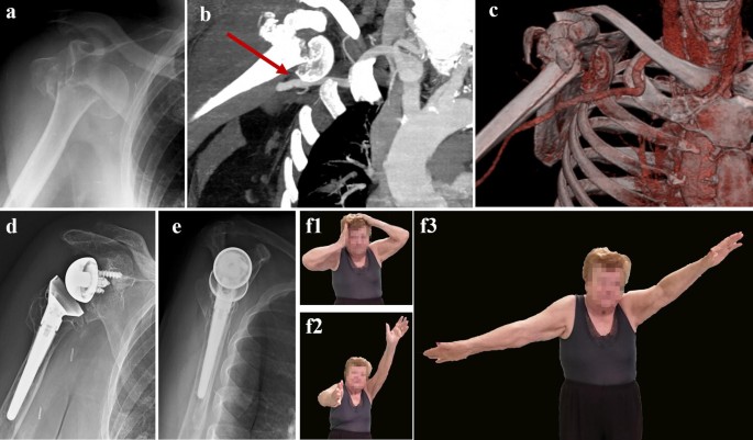 Acute Deep Venous Thrombosis And Late Onset Axillary Artery Injury After A Displaced Proximal Humerus Fracture Dislocation In An Octogenarian Patient Springerlink