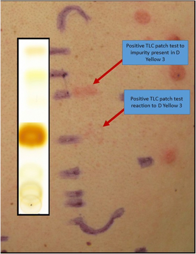 Textile Dermatitis: All About Latex Hypersensitivity & Polyester