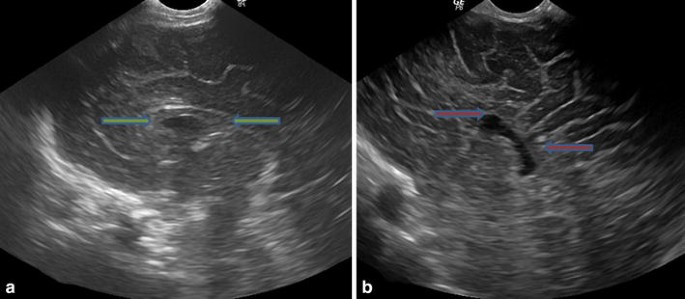 Antenatal Diagnosis Of Corpus Callosal Agenesis Springerlink Antenatal Diagnosis Of Corpus Callosal Agenesis Springerlink