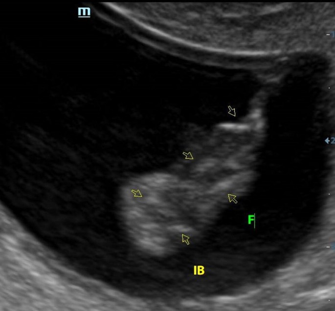 sirenomelia ultrasound