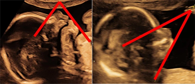 Normal Fetal Yüz Profili & Çenede Küçüklük