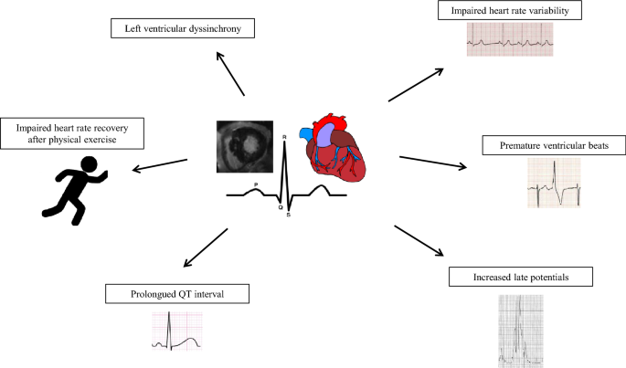 Electrophysiological Features In Acromegaly Re Thinking The Arrhythmic Risk Springerlink