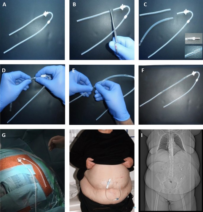 Intraperitoneal extension of the peritoneal dialysis catheter—a new technique for catheter implantation in patients with obesity | SpringerLink Intraperitoneal extension of the peritoneal dialysis catheter—a new technique for catheter implantation in patients with obesity | SpringerLink