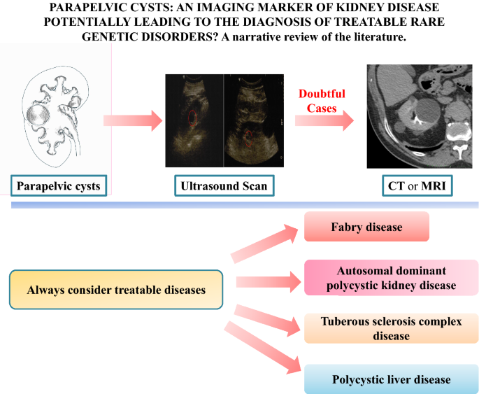 Parapelvic Cysts: An Imaging Marker of Kidney Disease Potentially Leading  to the Diagnosis of Treatable Rare Genetic Disorders? A Narrative Review of  the Literature | SpringerLink