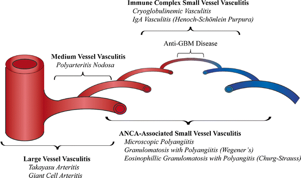Management of Vasculitic Glomerulonephritis | SpringerLink