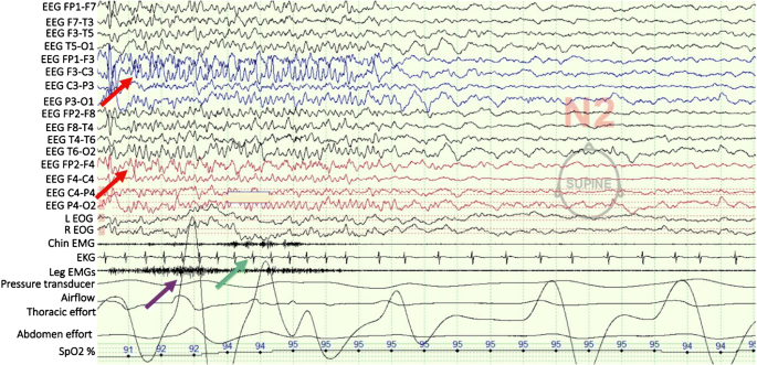 Clinician Focused Overview And Developments In Polysomnography Springerlink