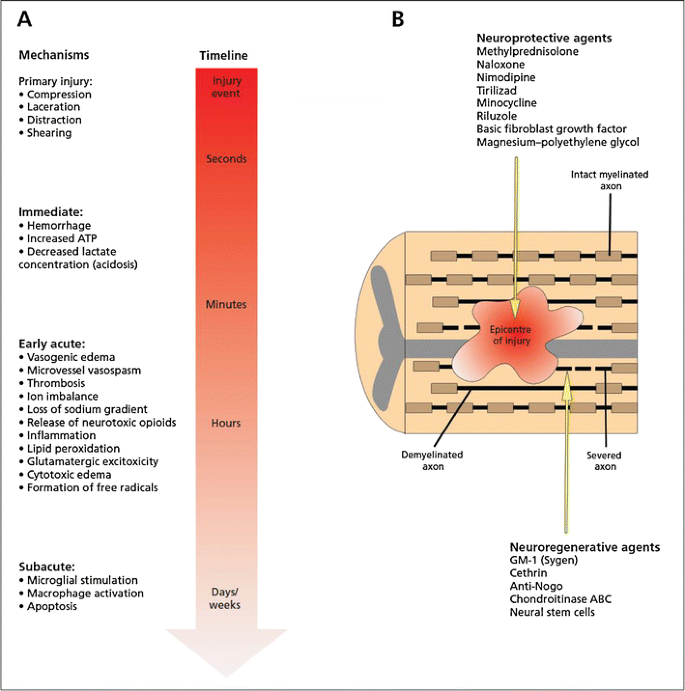 Diagnosis and Acute Management of Spinal Cord Injury: Current Best  Practices and Emerging Therapies | SpringerLink