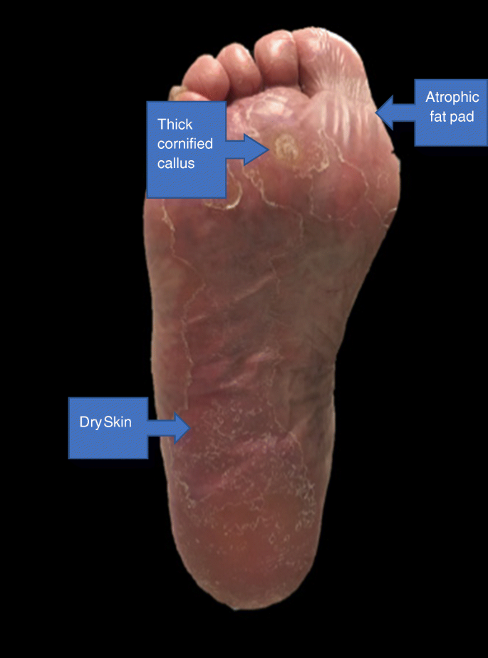 diabetic foot syndrome)