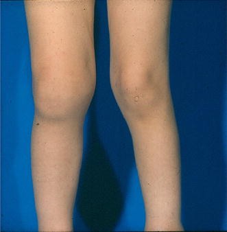 juvenile idiopathic arthritis pubmed)