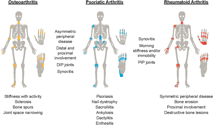 Differentiating Psoriatic Arthritis From Osteoarthritis And Rheumatoid  Arthritis: A Narrative Review And Guide For Advanced Practice Providers |  Springerlink