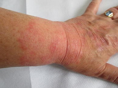 Diclofenac-Induced Allergic Contact Dermatitis: A Series of Four Patients |  Drug Safety - Case Reports