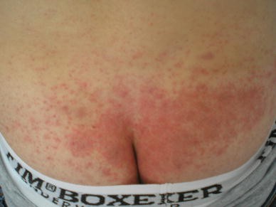 Diclofenac-Induced Allergic Contact Dermatitis: A Series of Four Patients |  Drug Safety - Case Reports