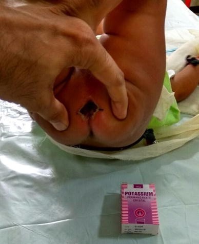 A Rare Case of Anal and Perianal Chemical Burn in a Child due to Potassium Permanganate Crystals | SpringerLink A Rare Case of Anal and Perianal Chemical Burn in a Child due to Potassium Permanganate Crystals | SpringerLink