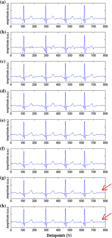 Method For Detecting Ventricular Activity Of Ecg Using Adaptive Threshold Springerlink