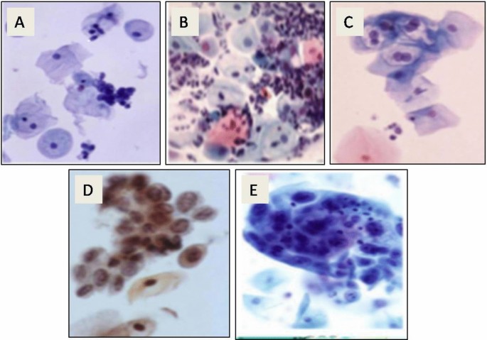 Role of PAP Smear Cytology and p16 Immunocytochemistry for Detection of  Cervical Lesions of Cervix: A Hospital-Based Study | SpringerLink